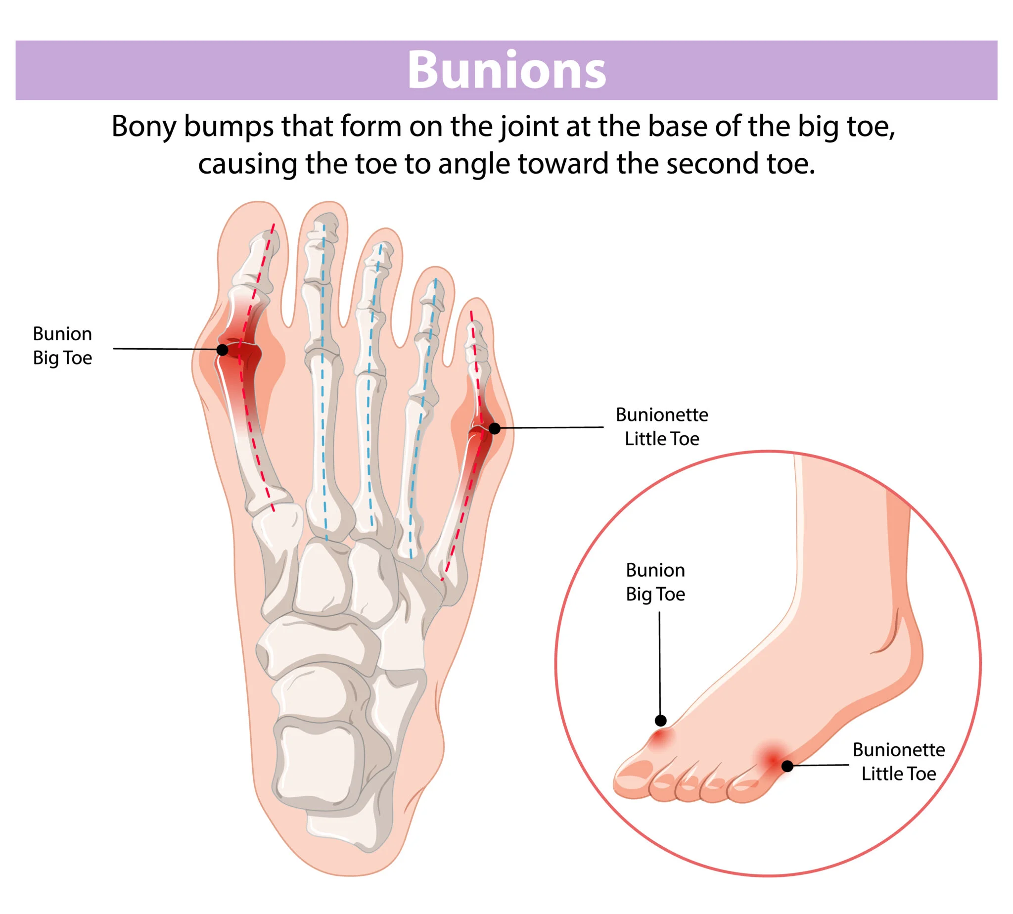 Bunion on foot showing bony bump at base of big toe